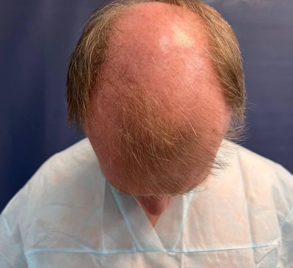 7 степень андрогенной алопеции, пересажено 6000 графтов (2) - фото до