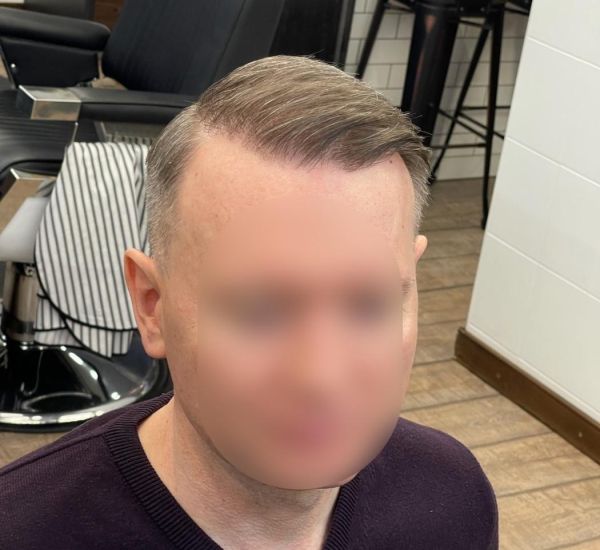 7 степень андрогенной алопеции, пересажено 6000 графтов (2) - фото после