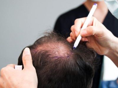 Реконструкция макушки