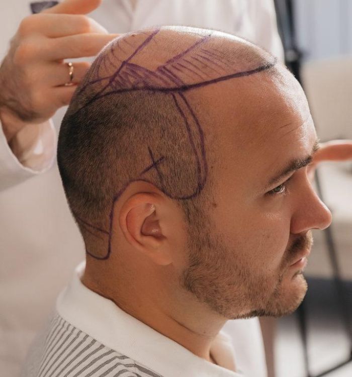 Мега-сессия пересадки волос (6000 графтов и более)