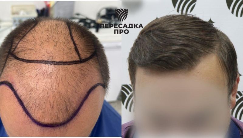 5-6 стадия облысения, пересажено 6000 графтов