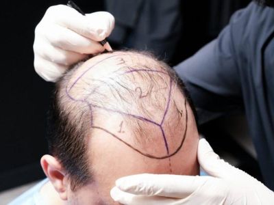 Комбинированная реконструкция краевой линии и макушки