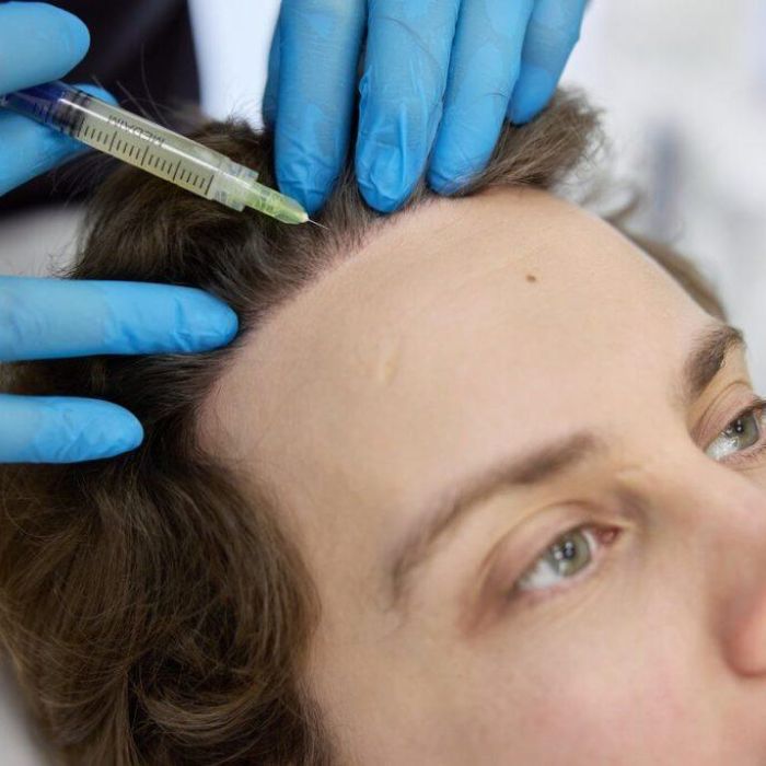 Пересадка волос при очаговой, рубцовой алопеции и после лучевой терапии