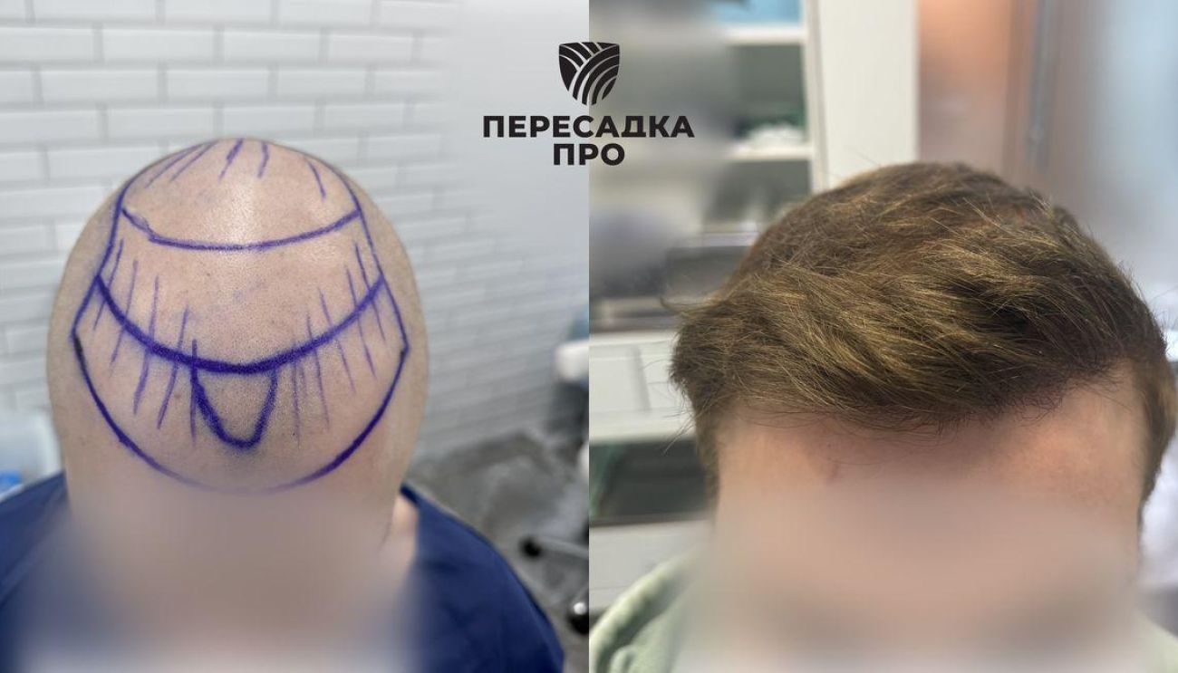 Пересадка 3000 графтов во фронтальную и среднюю зоны, 1000 в макушку