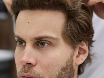 Реконструкция передней краевой линии волос