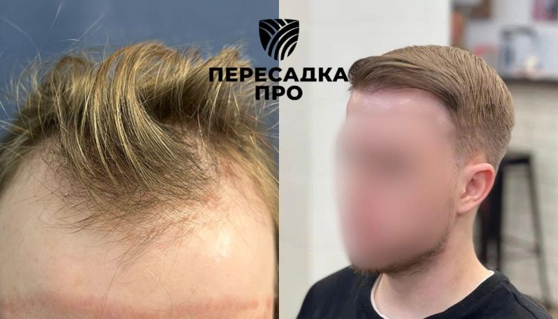 3 стадия облысения, пересажено 2500 графтов