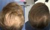 Поредение волос в области макушки, пересажено 2000 графтов