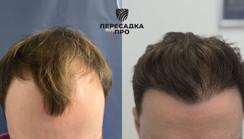 3-4 стадия облысения, пересажено 3500 графтов