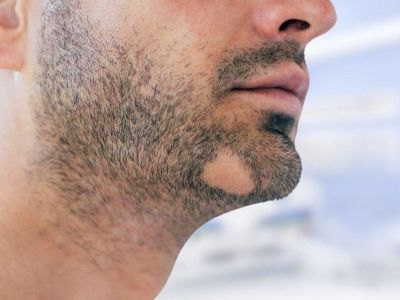 Пересадка бороды