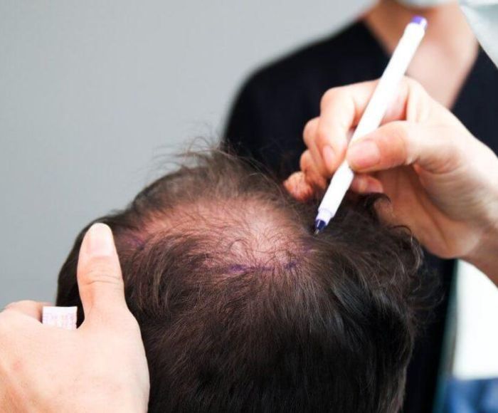 Реконструкция макушки