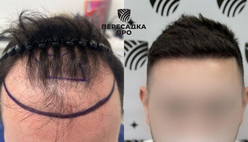 4-5 стадия облысения, пересажено 3500 графтов