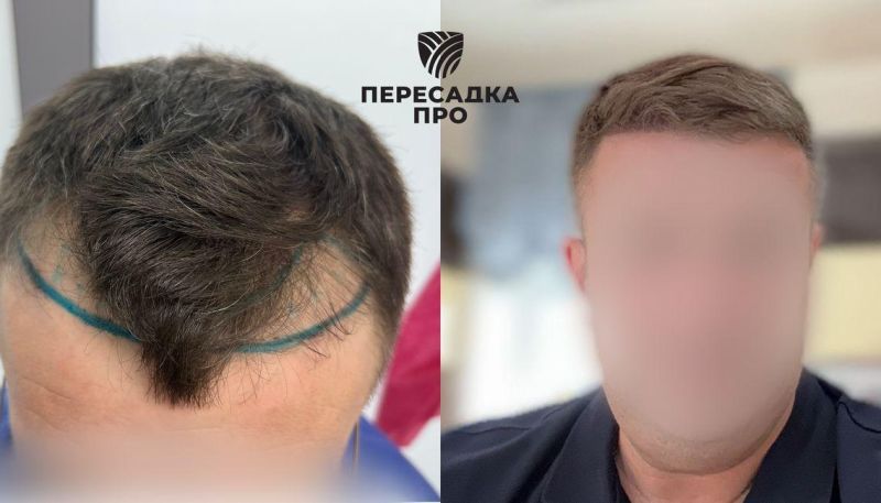 2 стадия облысения, пересажено 2500 графтов