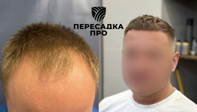 Пересадка 4000 графтов во фронтальную зону и 500 в среднюю