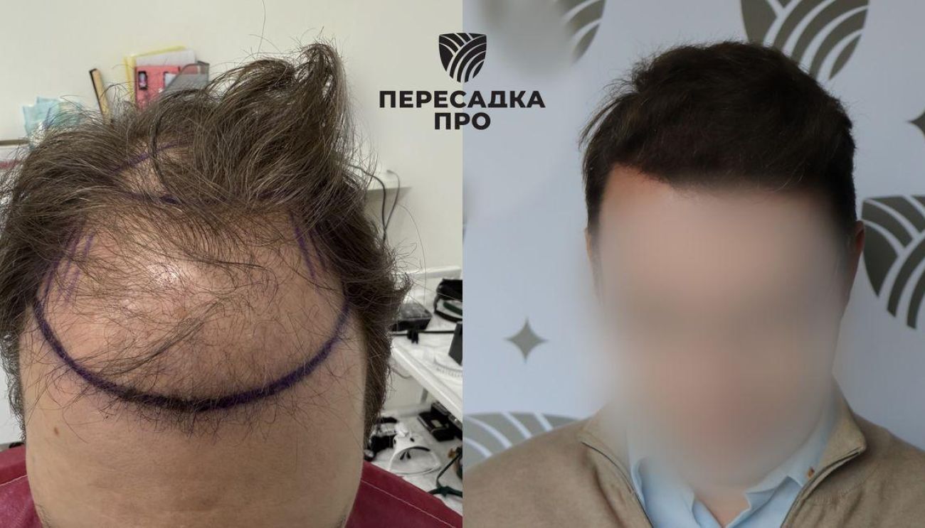 3-4 стадия облысения, пересажено 4500 графтов