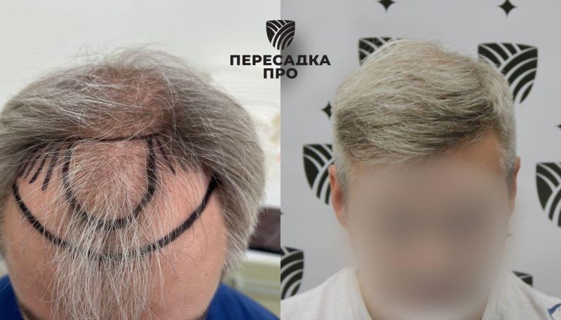 3-4 стадия облысения, пересажено 3000 графтов