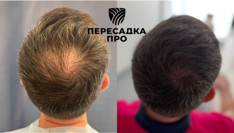 Поредение волос в области макушки, пересажено 1500 графтов