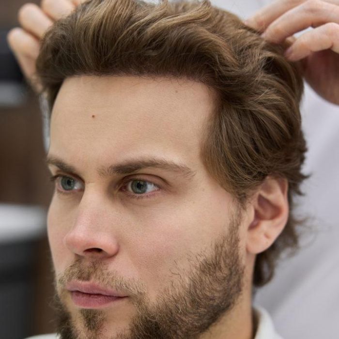 Реконструкция передней краевой линии волос