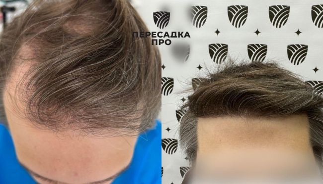 4-5 стадия облысения, пересажено 4500 графтов