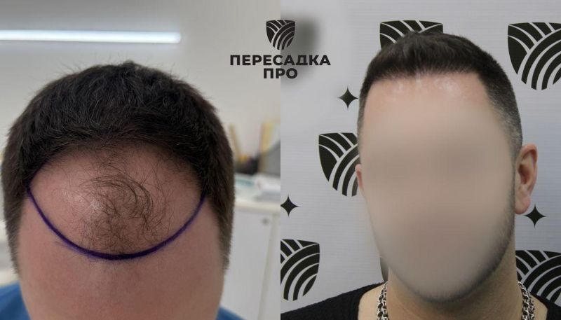 2-3 стадия облысения, пересажено 3000 графтов