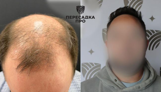 7 стадия облысения, пересажено 7500 графтов в область макушки