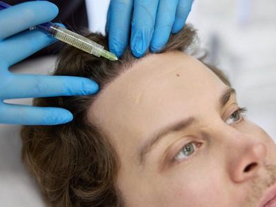 Пересадка волос при очаговой, рубцовой алопеции и после лучевой терапии