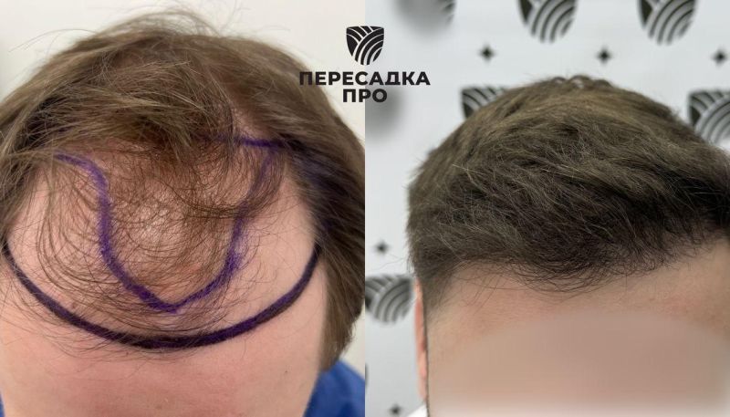 3-4 стадия облысения, пересажено 3500 графтов