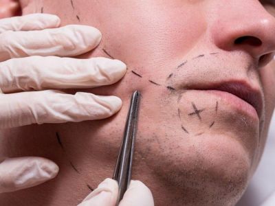 Мега-сессия пересадки бороды