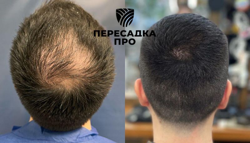 Пересадка 2500 графтов во фронтальную и среднюю зону