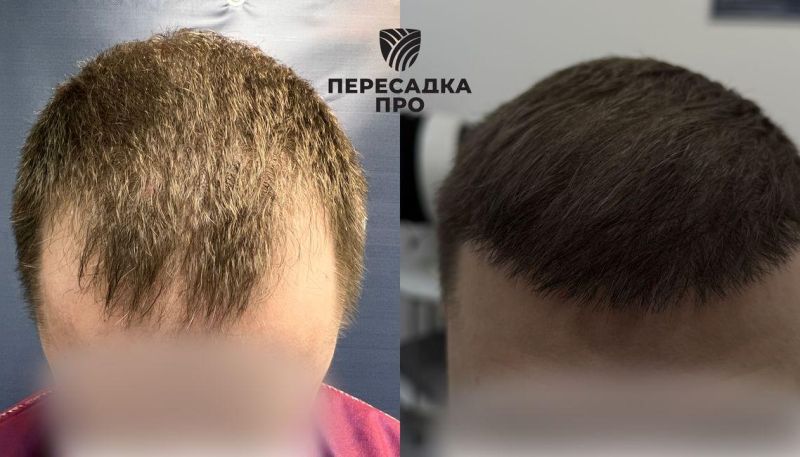 4 стадия облысения, пересажено 2000 графтов в область макушки
