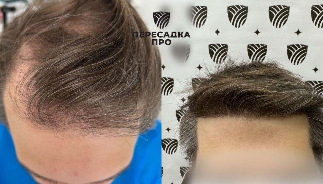 4-5 стадия облысения, пересажено 4500 графтов