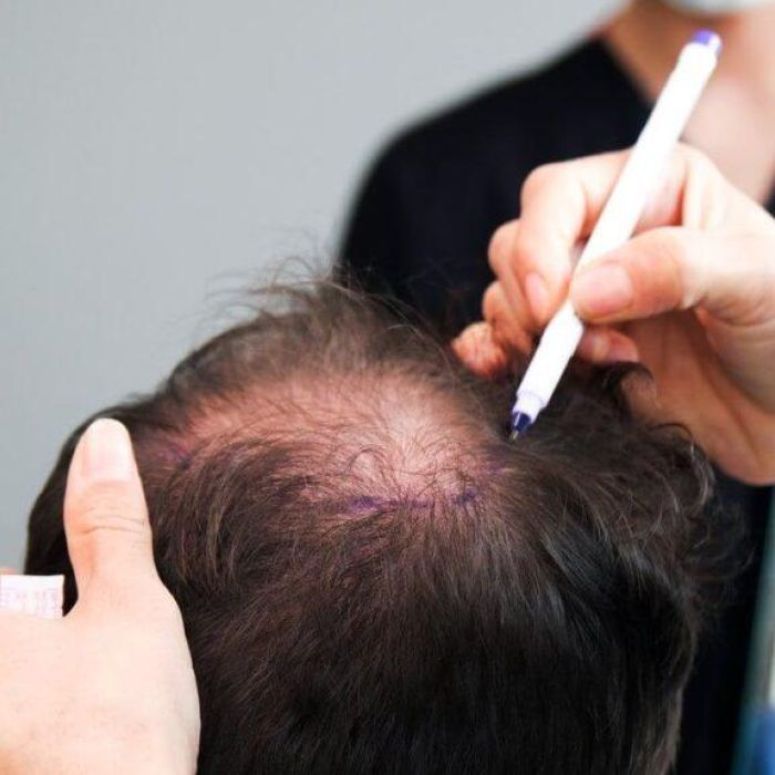 Реконструкция макушки