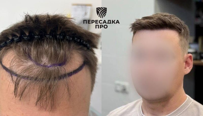 Пересадка 2900 графтов для эстетического изменения краевой линии