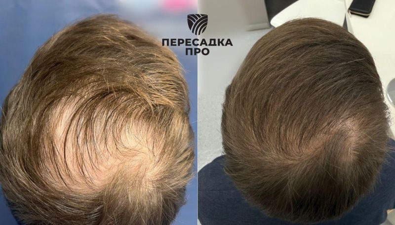 Поредение волос в области макушки, пересажено 2000 графтов