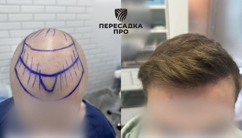 Пересадка 3000 графтов во фронтальную и среднюю зоны, 1000 в макушку
