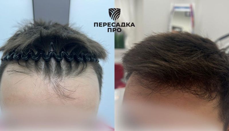 Пересадка 1500 графтов