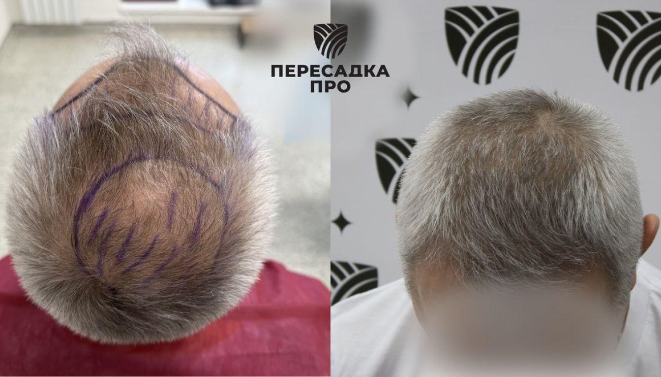 Пересадка 2000 графтов во фронтальную зону и 2000 в область макушки