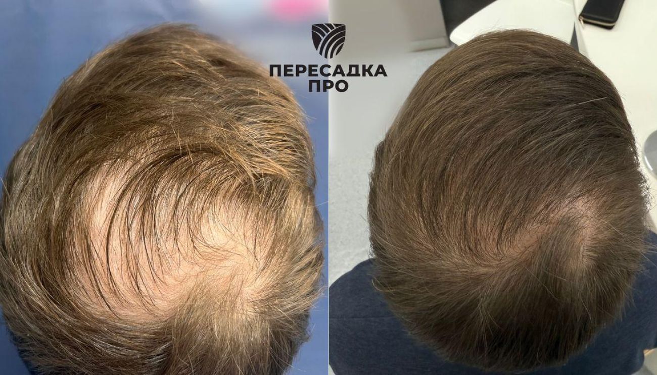 Поредение волос в области макушки, пересажено 2000 графтов