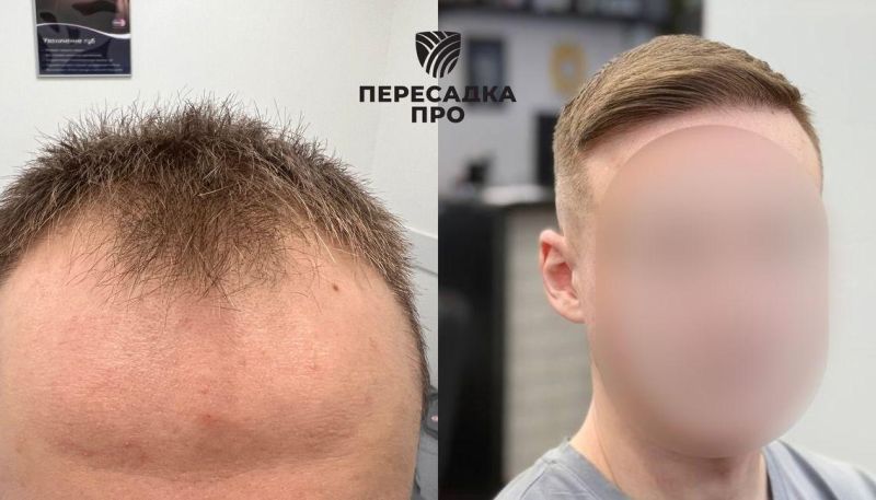 3-4 стадия облысения, пересажено 3800 графтов