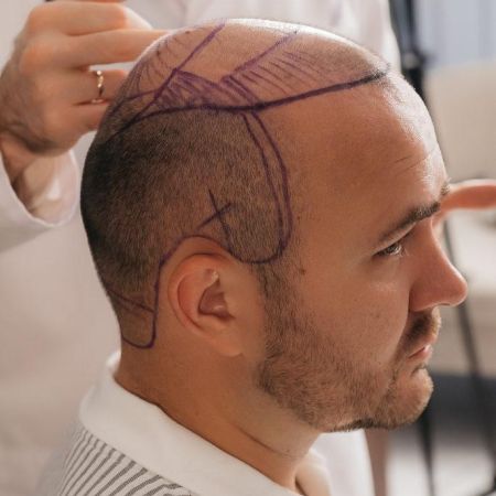 Мега-сессия пересадки волос (6000 графтов и более)