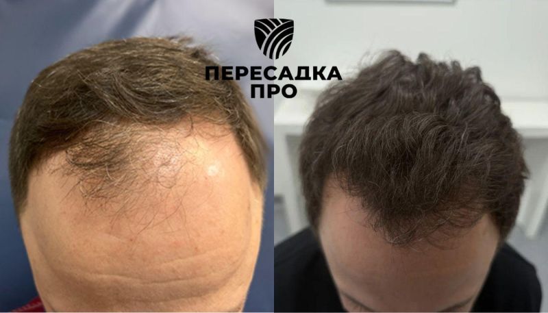 Поредение в области макушки, пересажено 2000 графтов