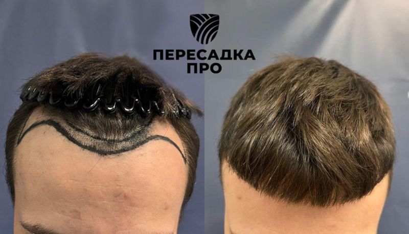 Эстетическое изменение краевой линии, пересажено 1500 графтов