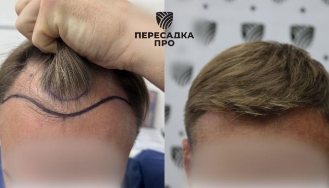 3-4 стадия облысения, пересажено 3200 графтов