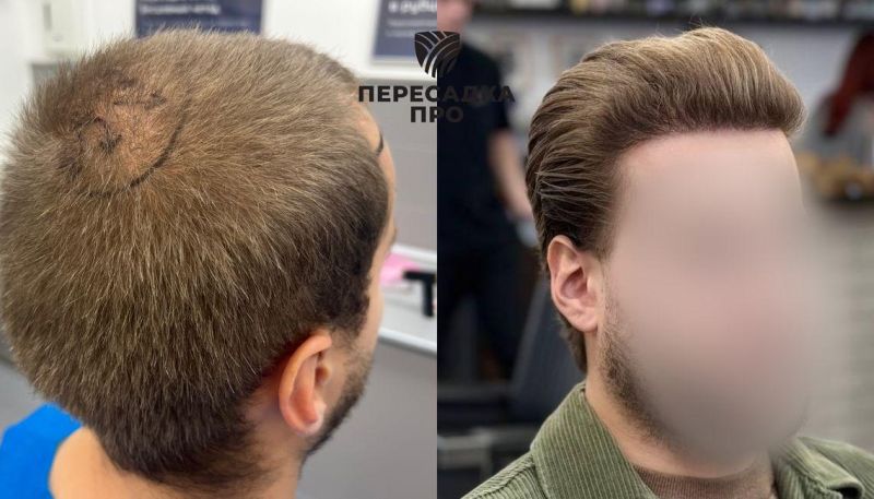 2-3 стадия облысения, пересажено 3700 графтов