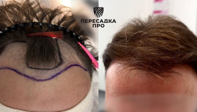 Пересадка 2000 графтов во фронтальную зону