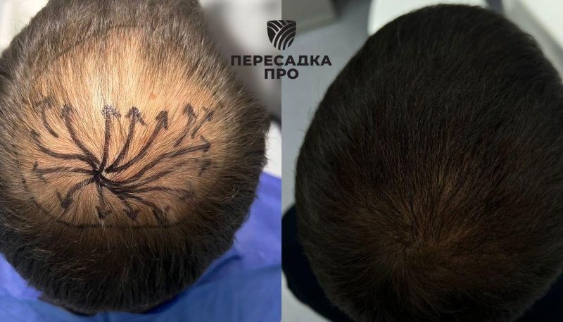 3 стадия облысения, пересажено 2000 графтов